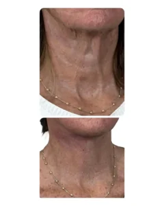 Before-and-after deep plane neck lift result by Dr. Vipul Gargya in Tampa, showing a smoother neck, improved jawline-to-neck contour, reduced neck banding, and natural-looking facial rejuvenation.