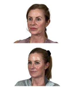 Deep plane facelift and neck lift before and after oblique view with facial fat transfer and eye rejuvenation by Dr. Vipul Gargya in Tampa, Florida.