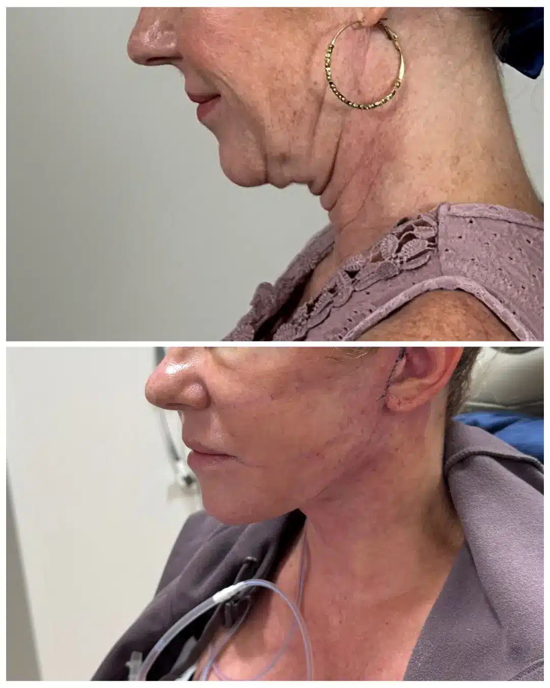 Early neck recovery. Top: before surgery. Bottom: postoperative day one.