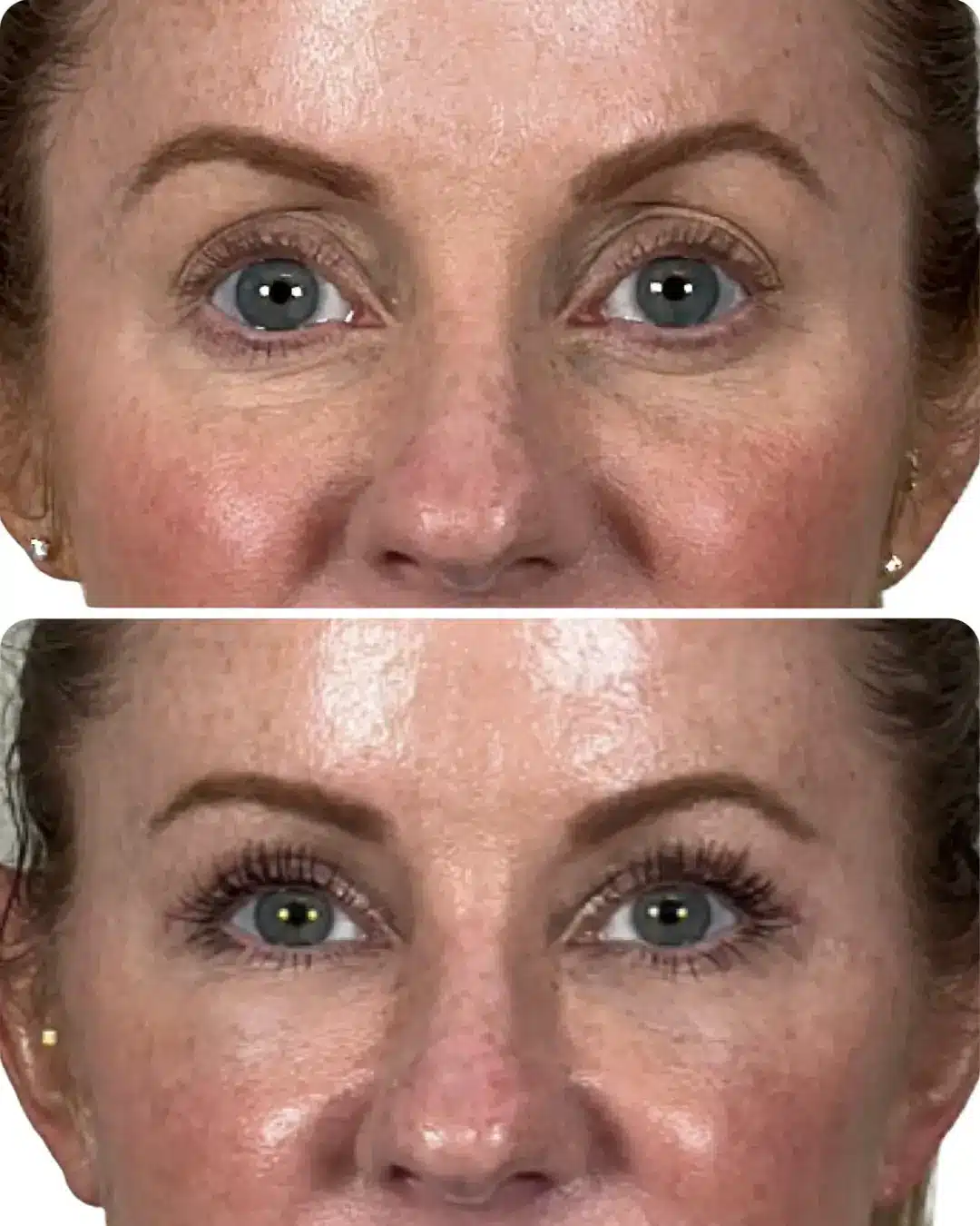 Before-and-after upper blepharoplasty and facial fat transfer by Dr. Vipul Gargya in Tampa, showing improved upper eyelid contour, periorbital fullness, and a smoother tear trough and lid-cheek transition at 3 months post-op.